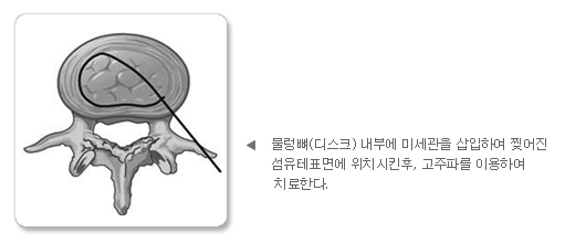물렁뼈(디스크)내부에 미세관을 삽입하여 찢어진 섬유테표면에 위치시킨후, 고자파를 이용하여 치료한다.
