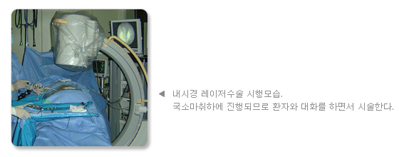 내시경 레이저수술 시행모습. 국소마취하에 진행되므로 환자와 대화를 하면서 시술한다.