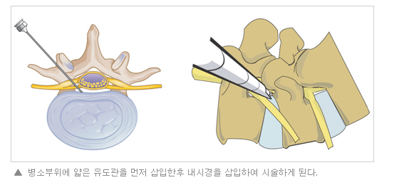 병소부위에 얇은 유도관을 먼저 삽입한 후 내시경을 삽입하여 시술하게 된다.