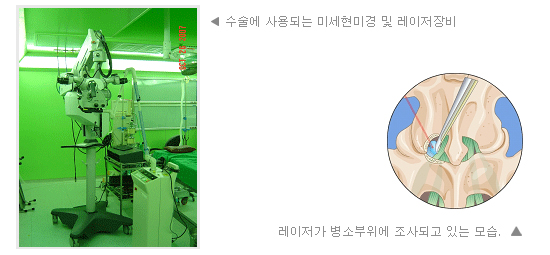 수술에 사용되는 미세현미경 및 레이저장비/레이저가 병소부위에 조사되있는 모습