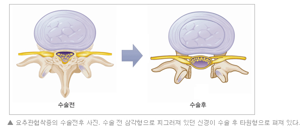 요추관협착증의 수술전후 사진. 수술 전 삼각형으로 찌그러져 있던 신경이 수술 후 타원형으로 퍼져 있다.