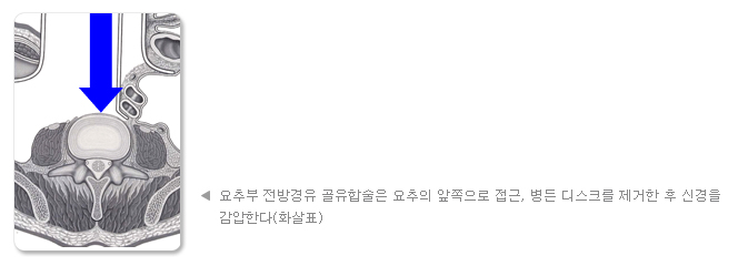 요추부 전방경유 골유합술은 요추의 앞쪽으로 접근, 병든 디스크를 제거한 후 신경을 감압한다(화살표)