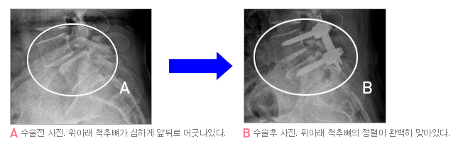 A. 수술전 사진. 위아래 척추뼈가 심하게 앞뒤로 어긋나있다.
B. 수술후 사진. 위아래 척추뼈의 정렬이 완벽히 맞아있다.