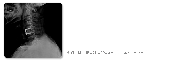 경추의 한분절에 골유합술이 된 수술후 X선 사진