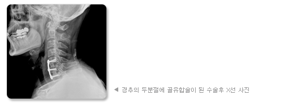 경추의 두분절에 골유합술이 된 수술후 X선 사진