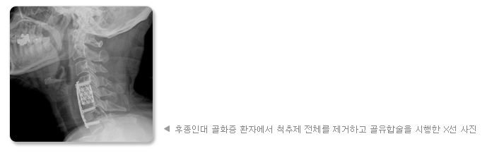 후종인대 골화증 환자에서 척추제 전체를 제거하고 골유합술을 시행한 X선 사진