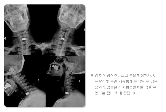 경추 인공척추디스크 수술후 X선사진. 수술직후 목을 자유롭게 움직일 수 있는 점과, 인접분절의 퇴행성변화를 막을 수 있다는 점이 최대 장점이다.