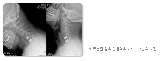 두분절 경추 인공척추디스크 수술후 사진.