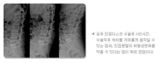 요추 인공디스크 수술후 X선사진. 수술직후 허리를 자유롭게 움직일 수 있는 점과, 인접분절의 퇴행성변화를 막을 수 있다는 점이 최대 장점이다.
