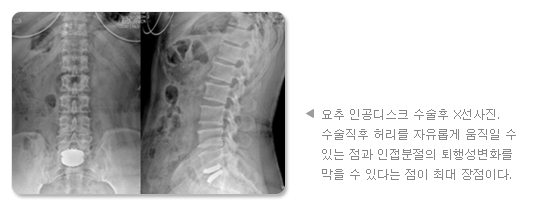 요추 인공디스크 수술후 X선사진. 수술직후 허리를 자유롭게 움직일 수 있는 점과, 인접분절의 퇴행성변화를 막을 수 있다는 점이 최대 장점이다.