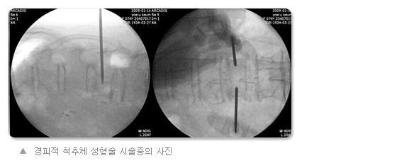 경피적 척추체 성형술 시술중의 사진