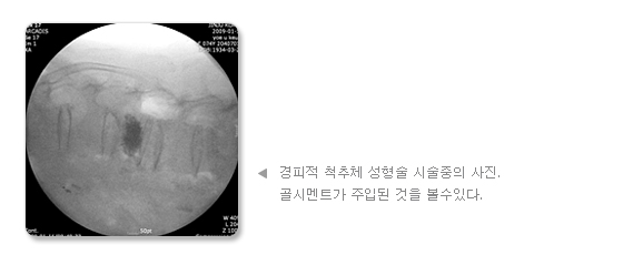 경피적 척추체 성형술 시술중의 사진. 골시멘트가 주입된 것을 볼수있다.