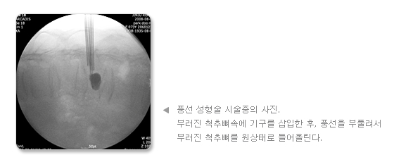 풍선 성형술 시술중의 사진. 부러진 척추뼈속에 기구를 삽입한 후, 풍선을 부풀려서 부러진 척추뼈를 원상태로 들어올린다.