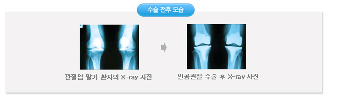 수술전후 모습 사진