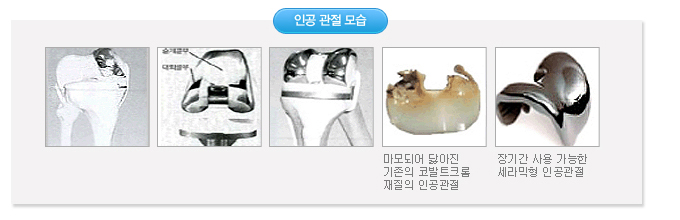 인공관절 모습 사진
